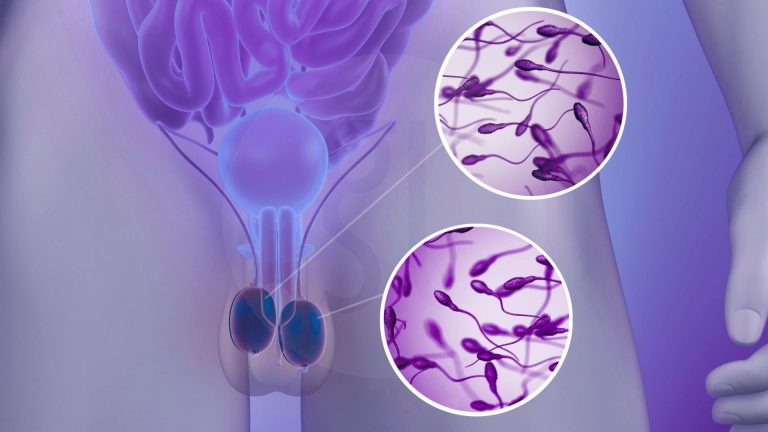TESE (استخراج الحيوانات المنوية من الخصية)